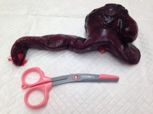 %e8%84%be%e8%87%93%e8%85%ab%e7%98%8d%e6%91%98%e5%87%ba