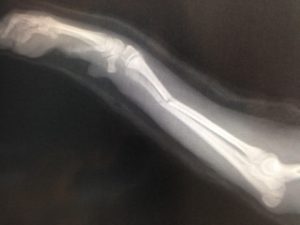 %e8%90%bd%e4%b8%8b%e9%aa%a8%e6%8a%98%ef%bc%95