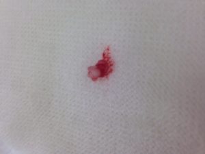 %e8%88%8c%e3%81%ae%e8%85%ab%e7%98%8d%ef%bc%92